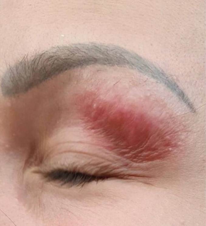 plazma pen iskustva tretman lica posledice