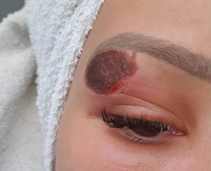 plazma pen iskustva tretman lica posledice