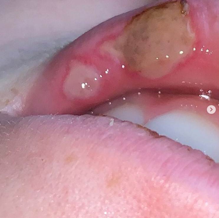 plazma pen iskustva tretman lica posledice