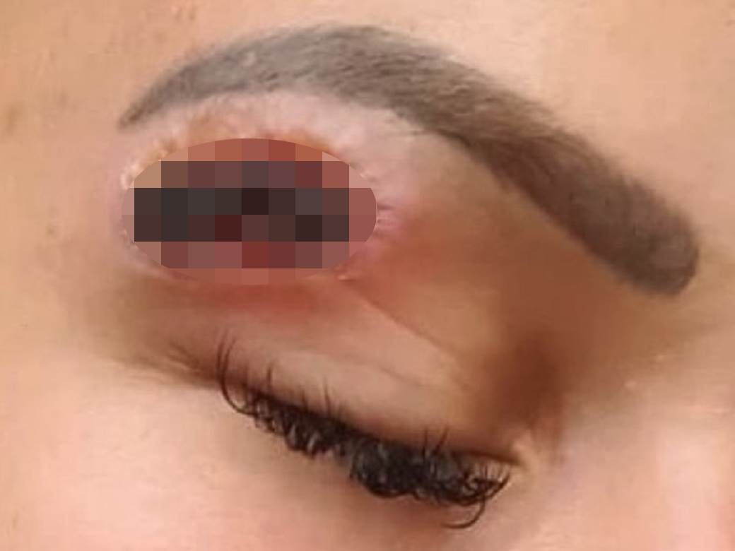 plazma pen iskustva tretman lica posledice