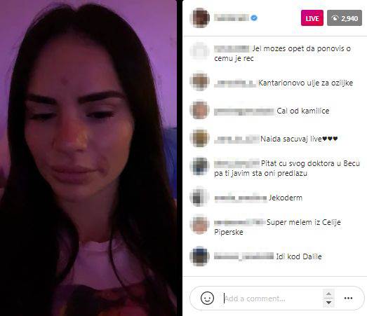 kozmeticki salon beograd opekotine na kozi naida gadzo instagram uzivo