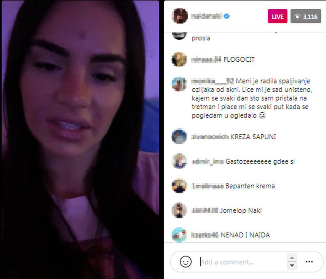 kozmeticki salon beograd opekotine na kozi naida gadzo instagram uzivo