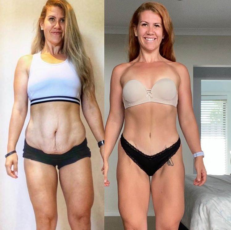 mrsavljenje iskustva kako smrsati zena skinula 50 kg