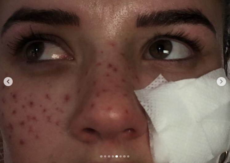 kucni tretmani za kozu posledice fotografije 