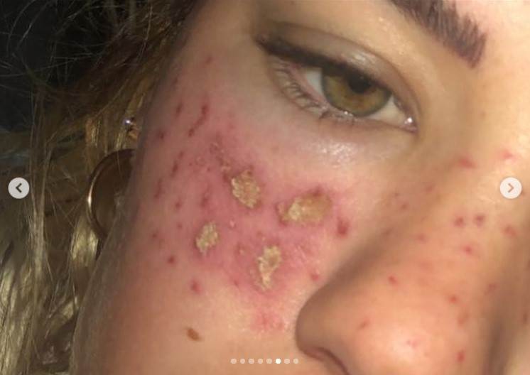 kucni tretmani za kozu posledice fotografije 