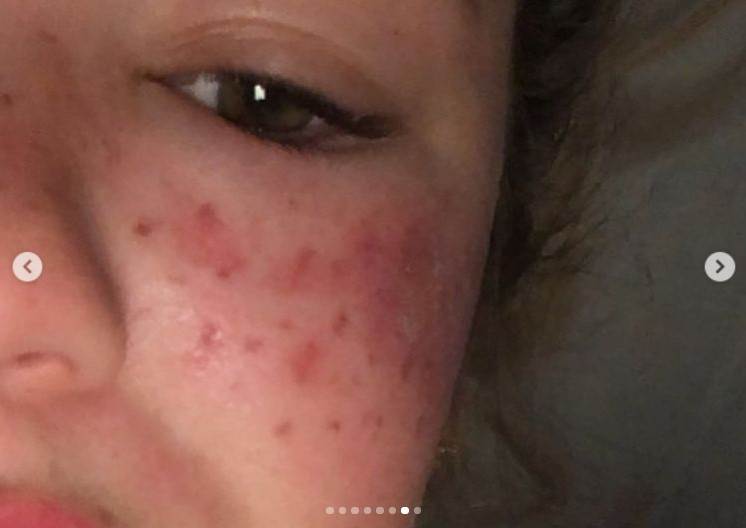 kucni tretmani za kozu posledice fotografije 