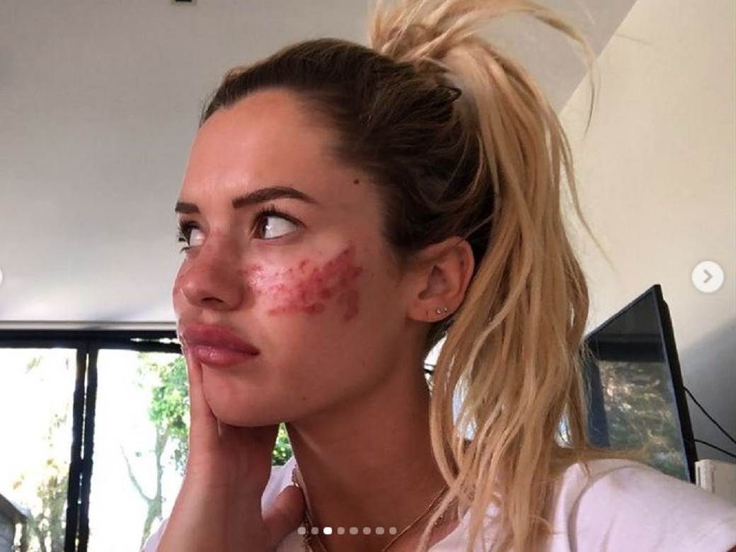 kucni tretmani za kozu posledice fotografije 