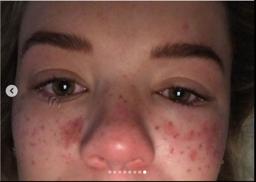 tretman za uklanjanje akni tiktok akupunktura unakazila lice drustvene mreze