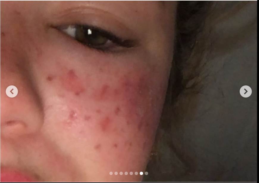 tretman za uklanjanje akni tiktok akupunktura unakazila lice drustvene mreze