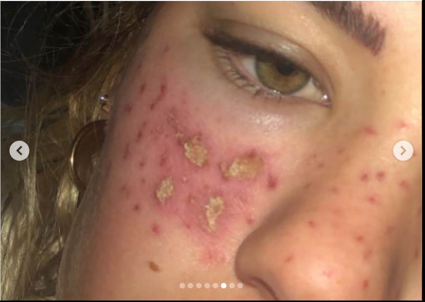 tretman za uklanjanje akni tiktok akupunktura unakazila lice drustvene mreze