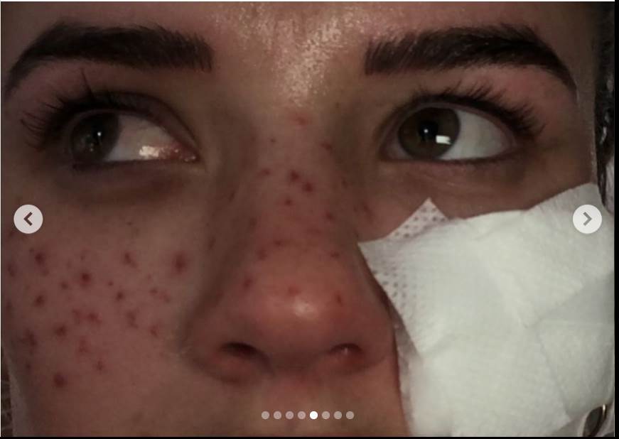 tretman za uklanjanje akni tiktok akupunktura unakazila lice drustvene mreze