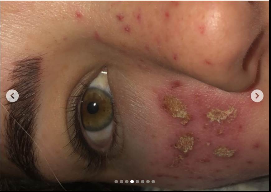 tretman za uklanjanje akni tiktok akupunktura unakazila lice drustvene mreze