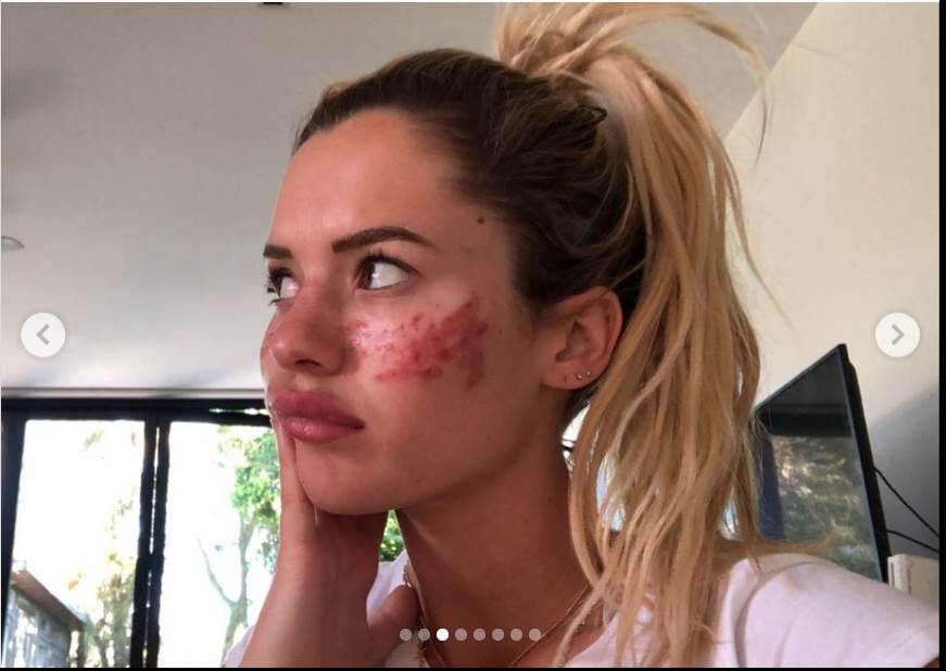 tretman za uklanjanje akni tiktok akupunktura unakazila lice drustvene mreze