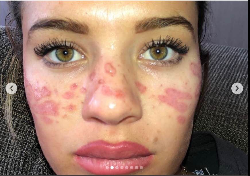 tretman za uklanjanje akni tiktok akupunktura unakazila lice drustvene mreze