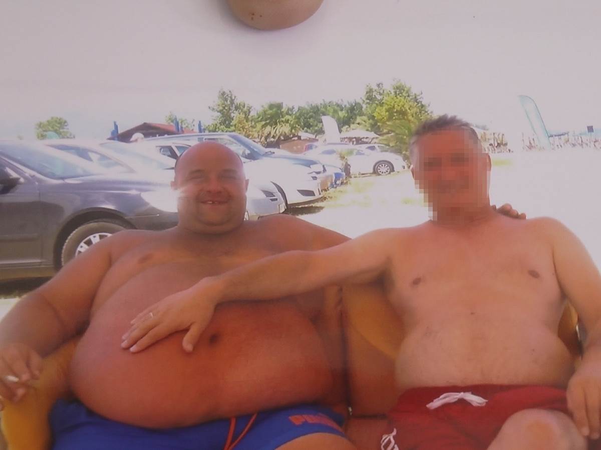 mrsavljenje operacija zeluca fotografije pre i posle iskustvo